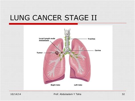 Lung cancer staging the noninvasive tools