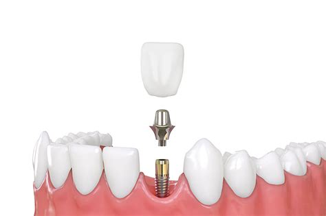 What are the Different Types of Dental Implants? - South Gables Dental