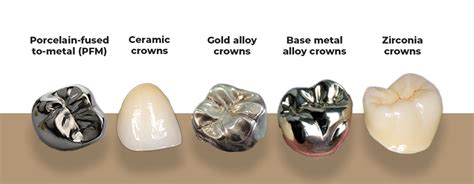 What Are Dental Crowns & How They Work? - Dentakay