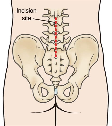 Spinal Fusion: Posterolateral Lumbar Fusion - OrthoInfo - AAOS