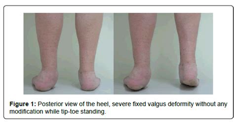 clinical-research-foot-Posterior-view-heel