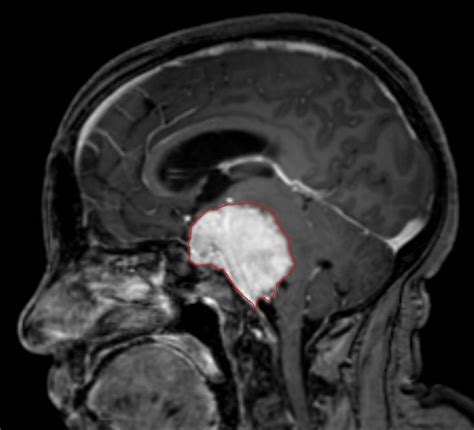 Petroclival Meningioma | Neuro Doctors