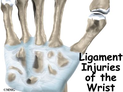 Ligament Injuries of the Wrist - Orthopedic Surgery, Algonquin, IL, Barrington, IL, Elgin, IL ...