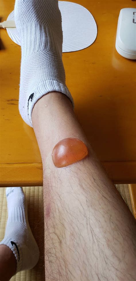 HUGE blister from mosquito(?) bite : r/AskDocs