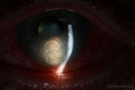 Scleral Edema