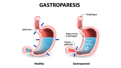 Gastroparesis – Symptoms, Complications & Diagnosis – Entirely Health