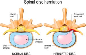 Herniated Disc Treatment and Symptoms | AllSpine