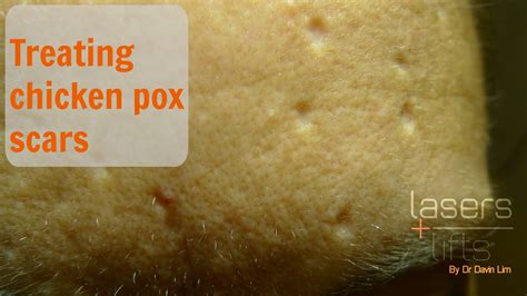 Outrageous Tips About How To Avoid Chicken Pox Scars - Treecurve