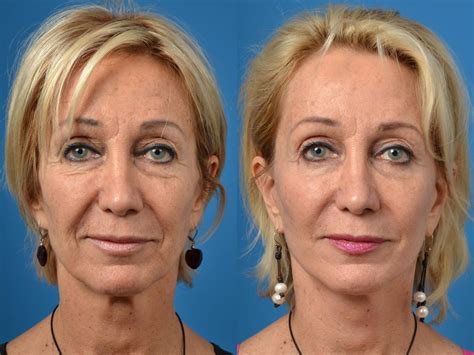 Facelift Photos | Melbourne, FL | Patient 52551