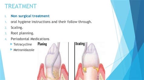 Periodontal pocket