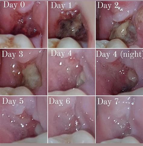 [Pics] 7 days of wisdom tooth extraction healing : r/wisdomteeth