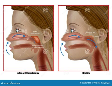 Enlarged Adenoid Glands Cartoon Vector | CartoonDealer.com #46045793