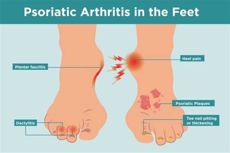 Psoriatic Arthritis in the Feet: Symptoms, Treatment, Home Remedies