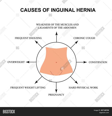 Inguinal Hernia Types