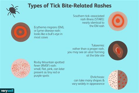 Lyme Disease Tick Bite Rash