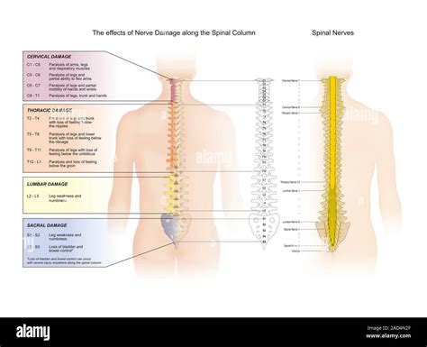 Spinal nerve damage. Labelled diagram of the effects of nerve damage along the spinal column ...