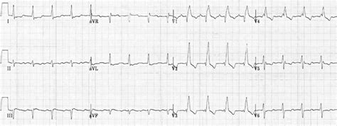 Right Bundle Branch Block (RBBB) • LITFL • ECG Library Diagnosis