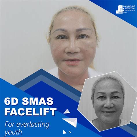 SMAS FACELIFT - LIFE-CHANGING RESULT AFTER ONLY 1 AMAZING PROCEDURE