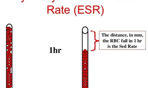 Erythrocyte sedimentation rate (ESR): principle, method, procedure and clinical application ...