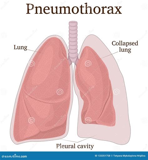 Illustration of Pneumothorax Stock Vector - Illustration of development ...