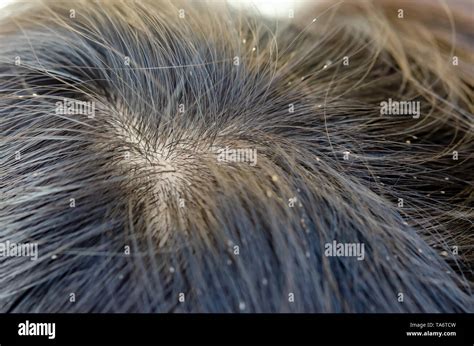 Head lice eggs hi-res stock photography and images - Alamy