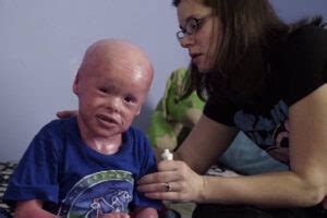 Harlequin Ichthyosis: Photos And Stories Of The Rare Skin Disease