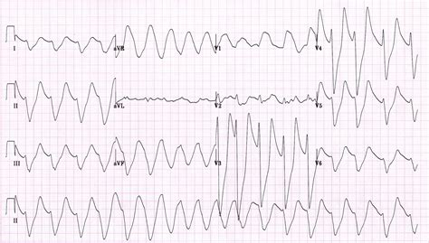 Sine Wave Hyperkalemia Ecg Changes