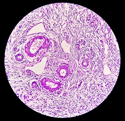 Histology Peritoneal Inclusion Cyst Paraovarian Cysts Hydrosalpinx And Lowgrade Cystic ...