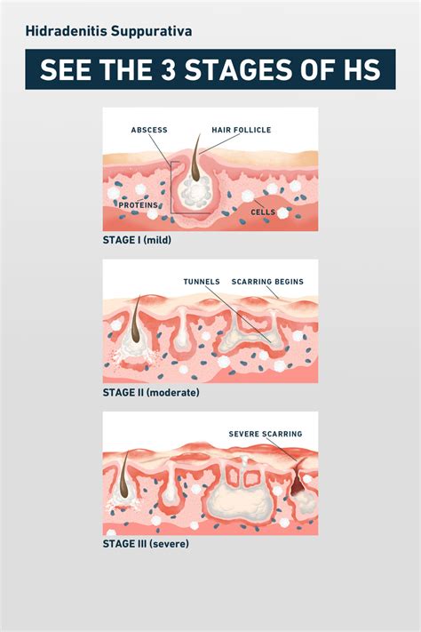 HS Symptoms & Pictures | No BS About HS