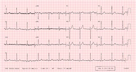 Normal Ecg Tracing