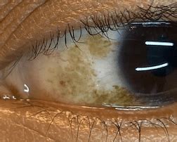 Conjunctival Nevus - Eye Freckle Laser Removal