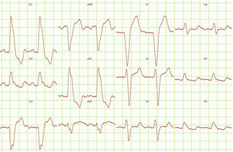 Left bundle branch block EKG examples - wikidoc