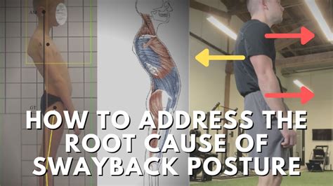 Swayback Posture