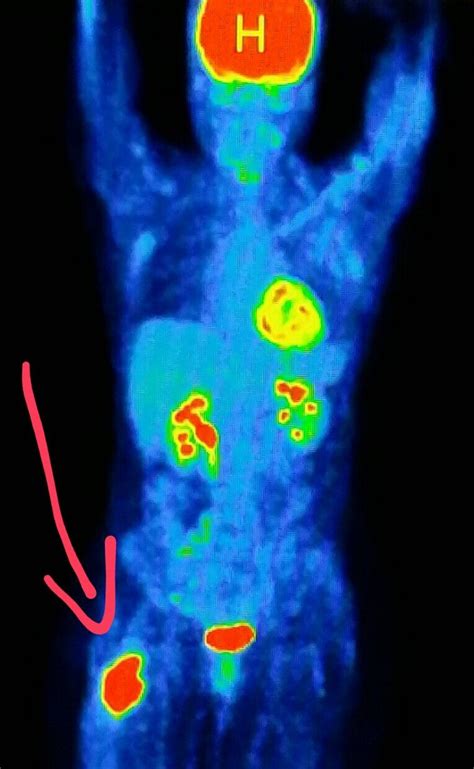 The Best Pet Scan Radiation 2023 - Radiation Effect