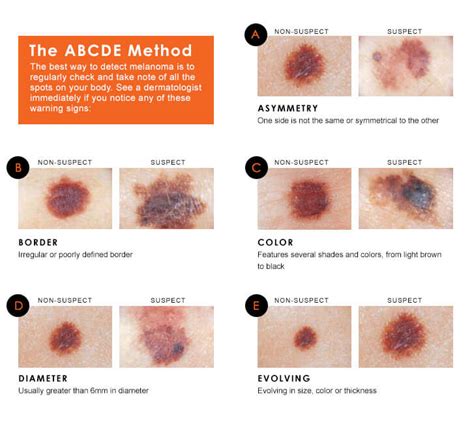 How To Spot The Early Signs Of Melanoma Skin Cancer | Babyface