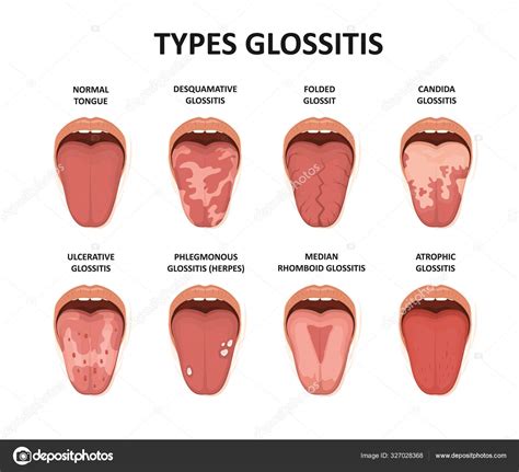 Tongue Disease