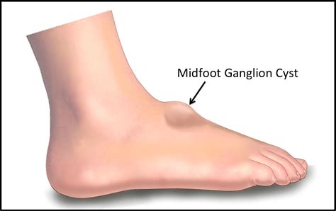 Ganglion Cysts - FootEducation