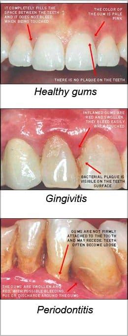 Gum Disease | Ramsey A. Amin, DDS