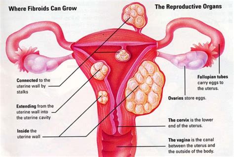 Normal Size Of Uterine Fibroids