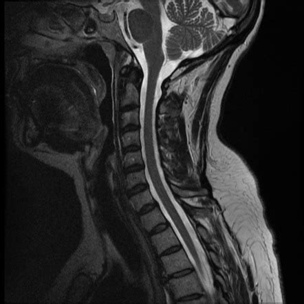 Abnormal Cervical Spine Mri