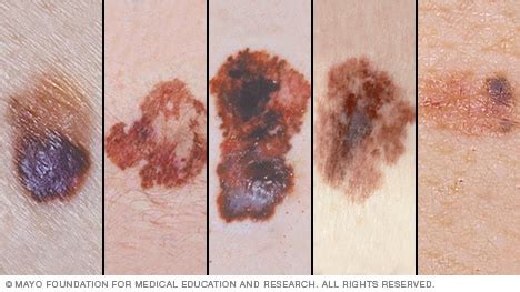 Slide show: Melanoma pictures to help identify skin cancer - Mayo Clinic