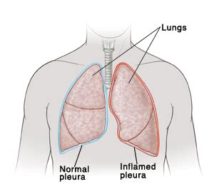 Pleurisy | Saint Luke's Health System