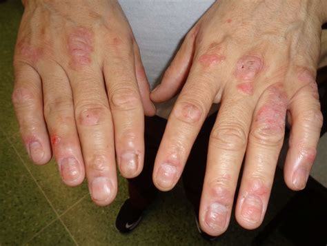 DermDx: Itchy Patches on the Hands - Dermatology Advisor