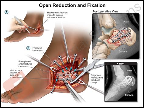 life after a calcaneus fracture surgery - Pearle Payton