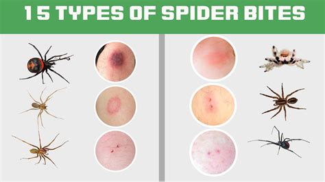 15 Types Of Spider Bites: Identification Chart with Picture