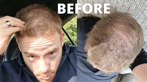 Balding Buzz Cut Before And After