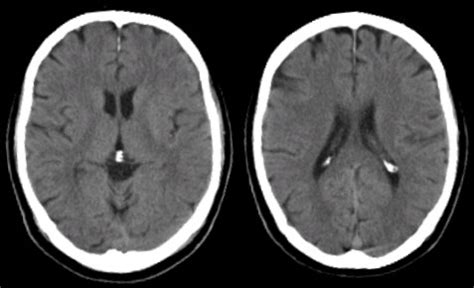 View Normal Brain Ct Scan Images US