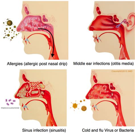 post-nasal-drip-causes - Pediatric Pulmonologists