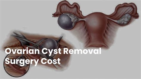 "The Cost of Ovarian Cyst Removal Surgery: What to Expect"