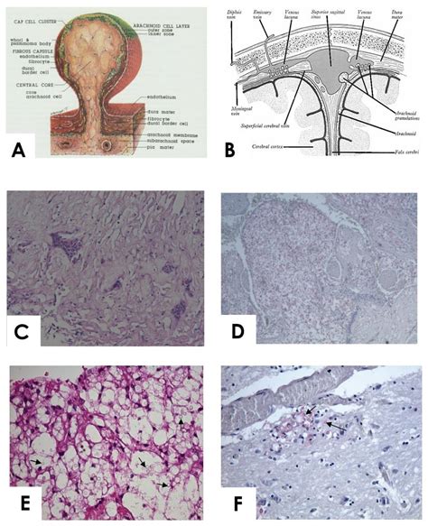 Arachnoid Granulations Histology